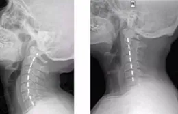 頸椎曲度變直，還能改善嗎？