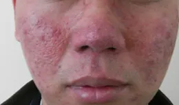 想讓痤瘡快點好，除了忌口，醫生說這5點調護措施也很重要