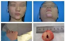 海薇玻尿酸是國產還是進口？熱門填充材料介紹，優點分析！