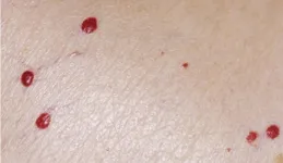 揭秘皮膚上紅色小點點的秘密
