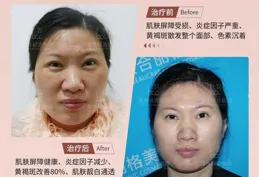 如何去除黃褐斑簡單方便？