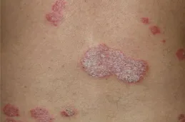 銀屑病怎麽才算「痊愈」？5個標準要達標才是真正「痊愈」