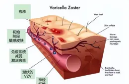 帶狀皰疹：讓人疼痛難忍，還可能是癌癥預警！這幾類人要特別警惕