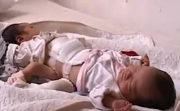 2009年湖北女子生下一對「連體嬰兒」，十年之後她們怎麽樣了