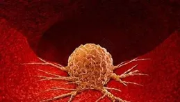 身上長「肉疙瘩」是患癌？醫生提醒：有這幾項異常，一定要註意！