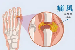 什麽原因會導致夜間膝關節疼痛？小心6種疾病可能！