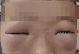 皮膚科接診多例螃蟹過敏患兒！秋日「蟹」逅，吃蟹註意這些更安全