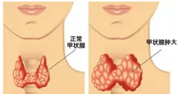 橋本氏甲狀腺炎是什麽意思？中醫藥能治療嗎？一文說清