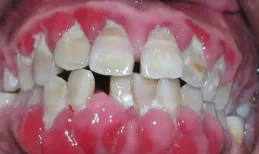 牙齦炎、牙周病，這些會讓牙齒掉光的病，遇到了該怎麽解決！