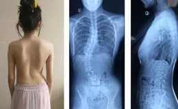 別讓孩子走「彎」路！預防脊柱側彎，守護健康成長