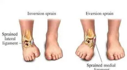 崴腳好了，為何又變成習慣性崴腳？這點不可忽視