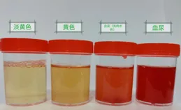 研究發現：只要尿檢這3個指標異常，千萬要重視，別拿自己開玩笑