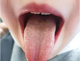 舌像怎樣看八綱？