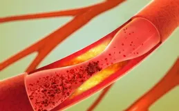 50歲男子堅持不吃晚餐，清除斑塊、軟化血管，半年後效果如何？