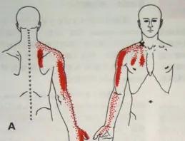 斜角肌（Scalene Muscles）肌筋膜激痛點