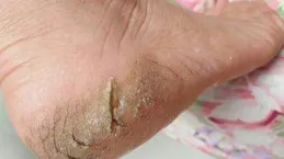 為什麽腳氣經常反復發作？