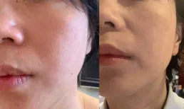 用完新的護膚品之後臉上大面積起皮，是新護膚品導致的問題嗎？