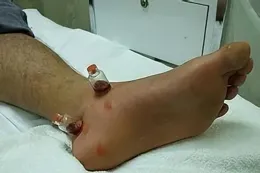 雪後冰凍路滑，不小心崴腳了怎麽辦？