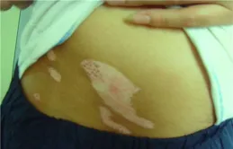 白癜風會對人體有什麽影響嗎？