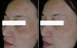 怎樣祛除黃褐斑？