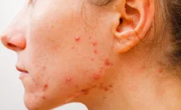 為什麽只有人類才會長痘痘？