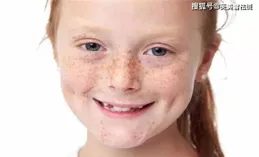 黃褐斑是哪兒來的？黃褐斑可以去嗎？