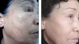 痘坑真能治好嗎？