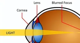 視網膜有裂孔，有失明風險嗎？
