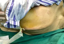 退變性脊柱側彎合並肺功能障礙患者髖關節置換手術的麻醉