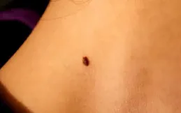 身體出現這種「肉痣」，可能是肝臟的「呼救訊號」，盡量不要忽視