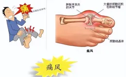 【豫健中醫】防治痛風，應該註意什麽？