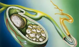 膽囊結石只能「一刀切」？「保膽取石」更好嗎？一文解答你的疑問