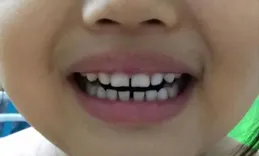 孩子牙縫大，在這個年齡段其實是好事，不要急著矯正