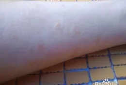 永遠不和健康開玩笑，治療白癜風沒有「愚人節」