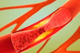 夜間睡覺時腿抽筋，是血管堵塞？醫生：不是缺鈣，還可能是1種病