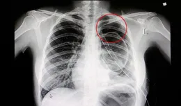 高三男孩踢球引發氣胸，會呼吸的痛：不要在勞累情況下高強度運動