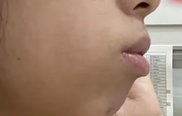 孩子脾胃差、腺樣體肥大，平時少吃這三類食物孩子一天比一天好！