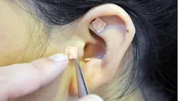 胖多囊，中醫助您開啟「熱辣滾燙」式健康減肥