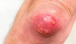 「癰證探微：頸癰、臍癰與臀癰的辨治之道」