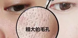 黑頭大到直接擠出來是什麽感受？