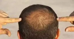 北京去哪裏植發價效比高？