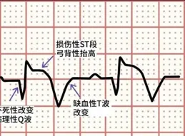 血液中這種酶升高，可能是心梗！