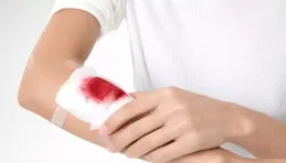 上個月受傷，觀察傷口愈合發現有些意思，記錄一下