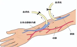 小小球囊撐起「小蠻腰」，守護透析患者的「生命線」！