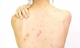 為什麽有些人後背長痘痘，是體質問題嗎？