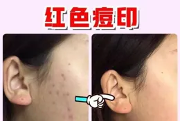 關於怎麽去除草莓鼻，各位大佬有什麽好方式！?