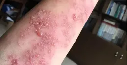 神奇的艾灸：看似病情「加重」，卻是身體好轉！