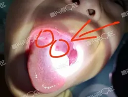 已經進入高發期，傳染性極強！嘉興人很多人中招了，警惕！