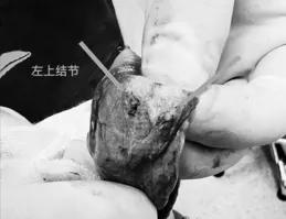 跟著我隨訪了5年，我覺得也可以考慮開刀，結果回看是否合適？