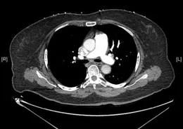 老年患者反復胸悶氣短3年，這個肺部疾病不容忽視！